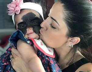 Мама девочки с родимым пятном на все лицо поблагодарила россиян за помощь