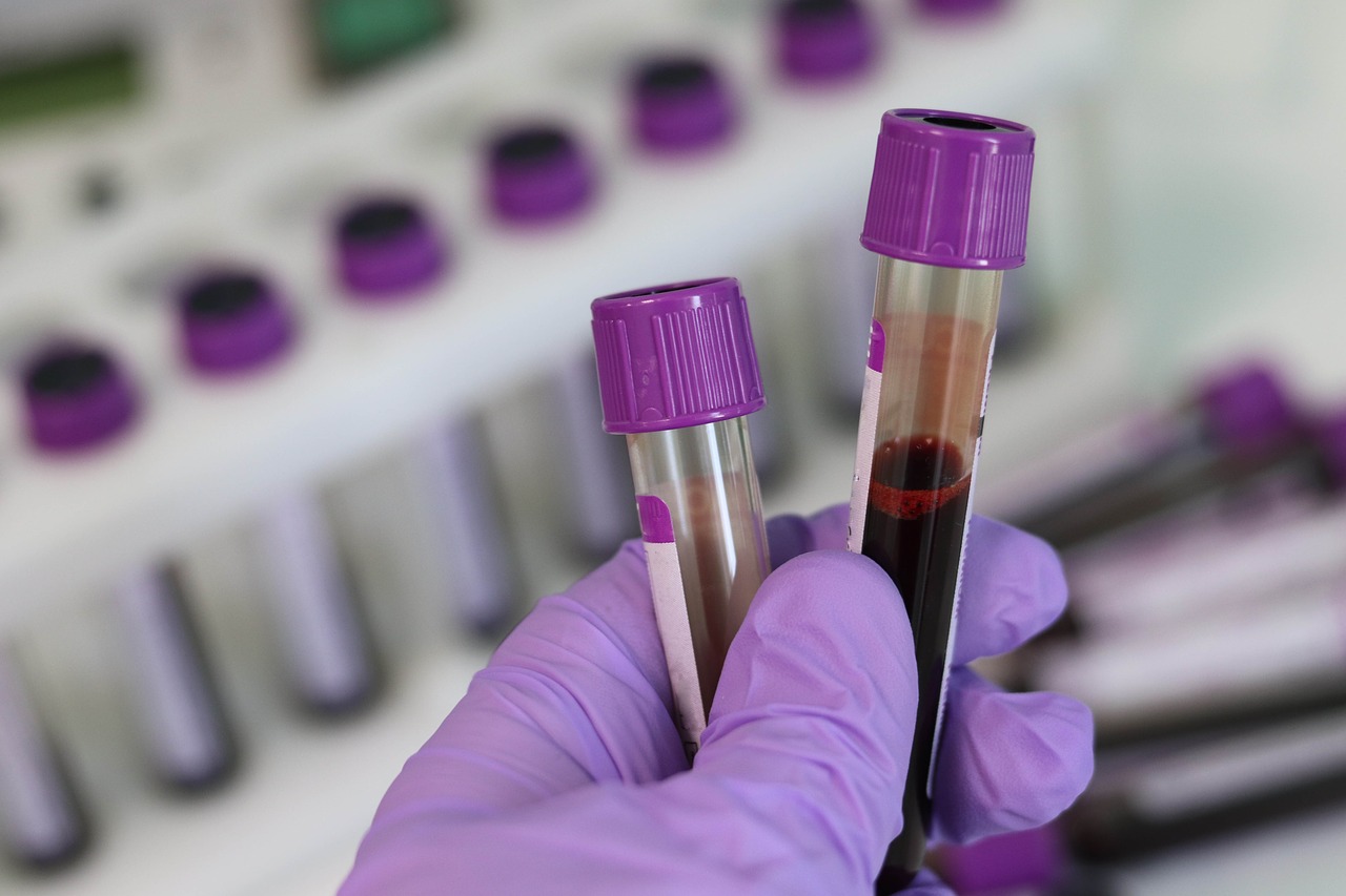 Стоимость общего анализа крови в России повысилась на 21 процент
